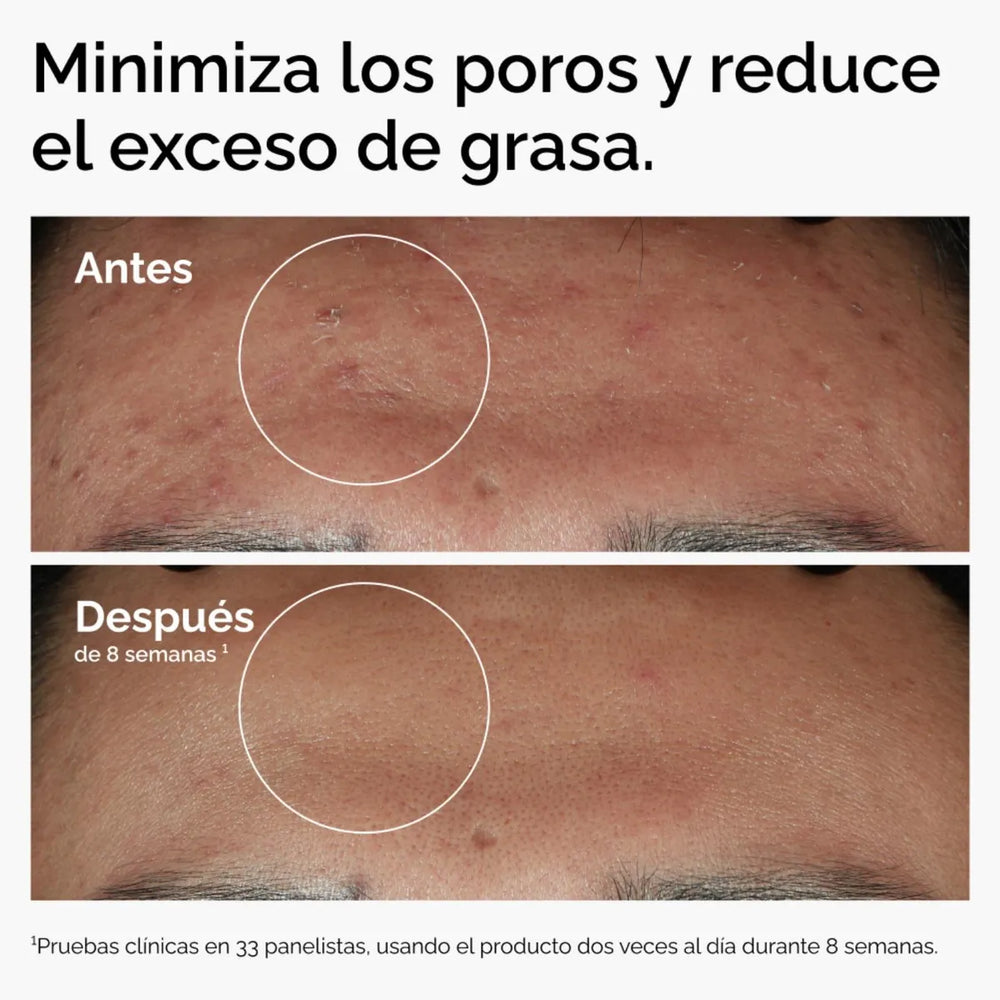 The Ordinary Niacinamide 10% + Zinc 1% – Sérum Facial Equilibrante y Control de Grasa