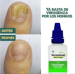 DermaHong Solución Tópica Antihongos 30ml – Tratamiento para Hongos en Uñas y Pies | Pack 3 Unidades 3 en 1