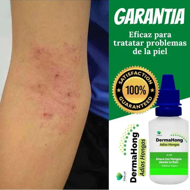 DermaHong Solución Tópica Antihongos 30ml – Tratamiento para Hongos en Uñas y Pies | Pack 3 Unidades 3 en 1