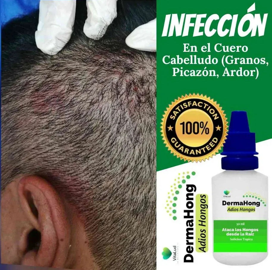 DermaHong Solución Tópica Antihongos 30ml – Tratamiento para Hongos en Uñas y Pies | Pack 3 Unidades 3 en 1