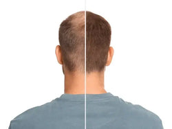 man-hair-loss-problem-before-600nw-2074480813_993eaa98-9162-46bc-b091-2babf76296b1 - Needify